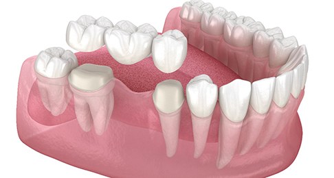 A 3D illustration of a traditional dental bridge in Southlake