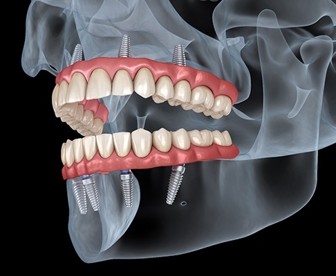 Illustration of All-on-4 in Southlake for upper and lower dental arches