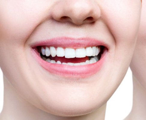 Before and after cosmetic dental bonding in Southlake   