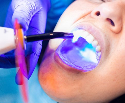Cosmetic dental bonding in Southlake   