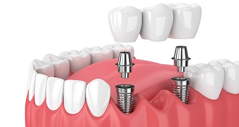 A 3D illustration of an implant dental bridge in Southlake