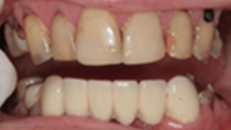 Smile with damaged teeth before restorative dentistry
