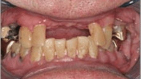 Smile with missing teeth before tooth replacement