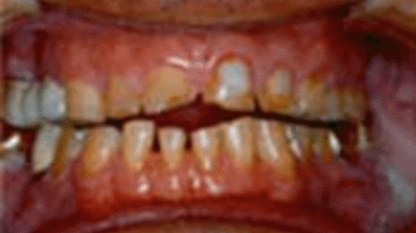 Severely decayed and discolored teeth