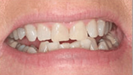 Worn and uneven teeth before cosmetic dentistry