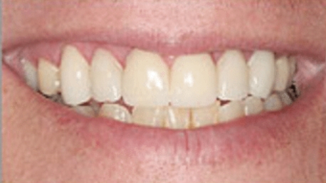 Healthy smile after restorative dentistry