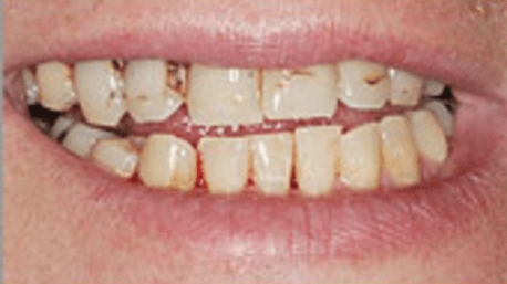 Smile with numerous teeth impacted by dental decay