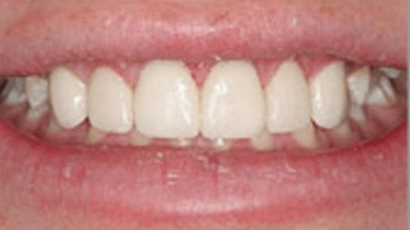 Perfectly aligned smile after orthodontic treatment