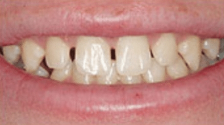 Unvenly spaced teeth before orthodontic treatment