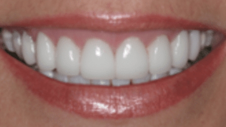 Brilliant white beautiful smile after teeth whitening