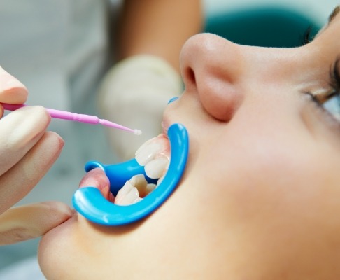 Young dental patient receiving silver diamine fluoride treatment