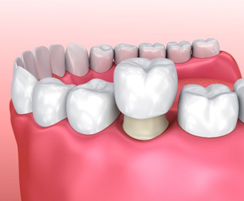 A 3D illustration of dental crowns in Southlake