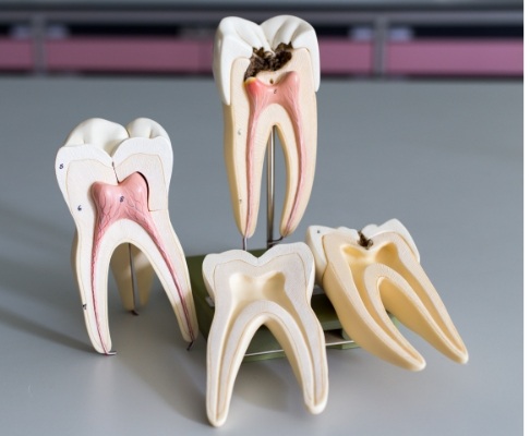 Model of inside of healthy tooth and tooth in need of root canal therapy