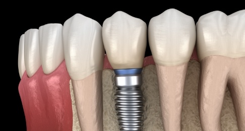Animated smile with a dental implant supported replacement