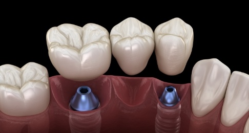 Animated smile during a dental implant supported fixed bridge placement