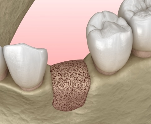 Animated smile after bone grafting