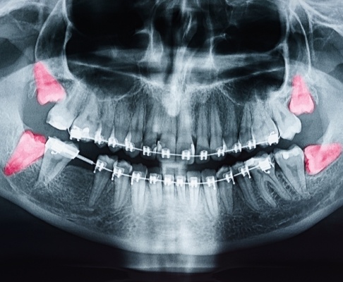 X-ray of smile with wisdom teeth that need to be extracted
