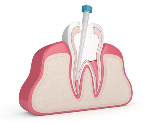 Illustration of tooth being filled during root canal therapy in Southlake, TX