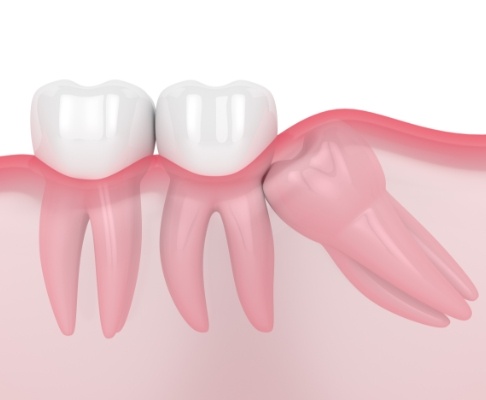 Animated smile with impacted wisdom tooth before extraction