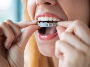 a woman trying on clear dental aligners