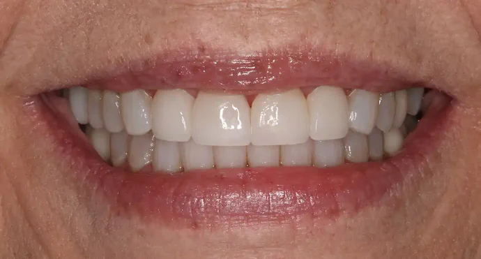 After 4 Dental Veneers in Southlake, TX at Huckabee Dental