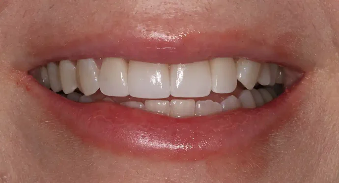 After 4 Porcelain Veneers in Southlake, TX at Huckabee Dental