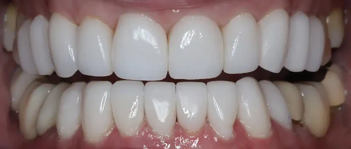 After full-mouth reconstruction in Southlake, TX at Huckabee Dental