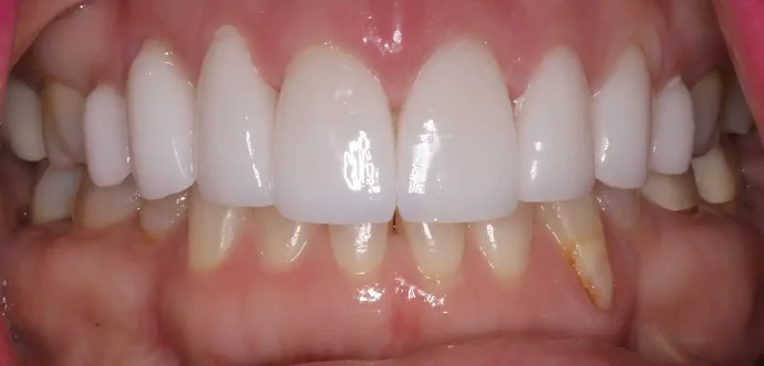 After old crown replacement in Southlake, TX at Huckabee Dental