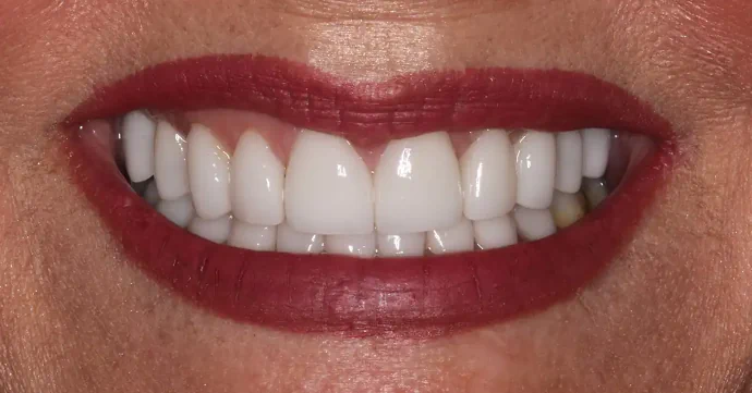 After a Smile Makeover at Huckabee Dental