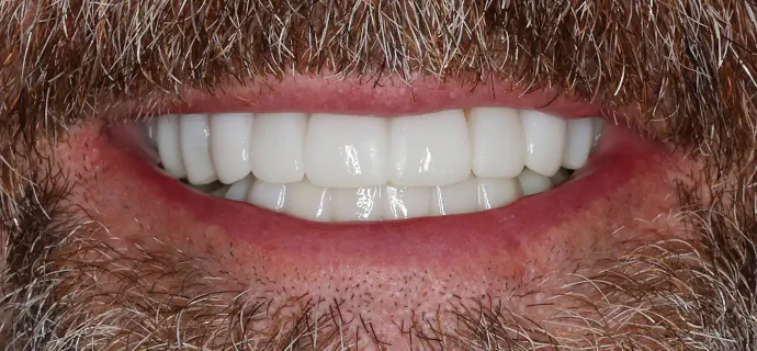 After Smile Makeover in Southlake, TX at Huckabee Dental