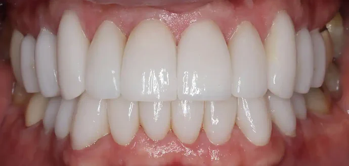 After Smile Makeover in Southlake, TX at Huckabee Dental