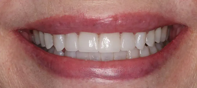 After teeth whitening and veneers in Southlake, TX at Huckabee Dental