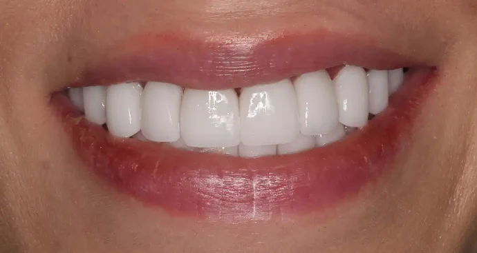 After Upper Veneers in Southlake, TX at Huckabee Dental