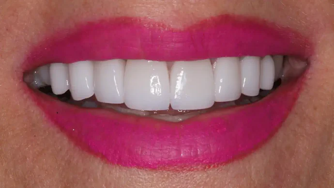 After 10 Upper Veneers in Southlake, TX at Huckabee Dental