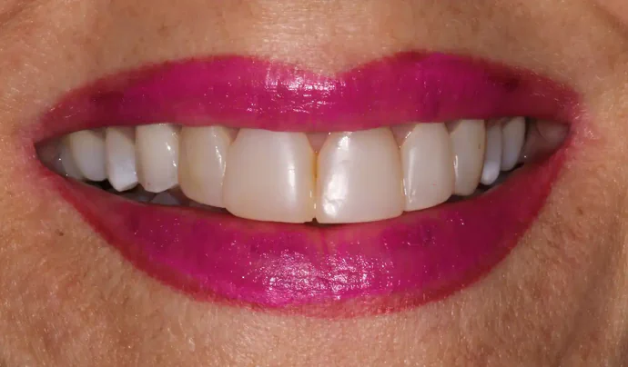 Before 10 Upper Veneers in Southlake, TX at Huckabee Dental