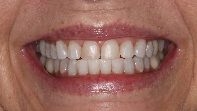 Before 4 Dental Veneers in Southlake, TX at Huckabee Dental