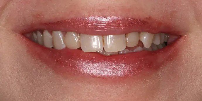 Before 4 Porcelain Veneers in Southlake, TX at Huckabee Dental