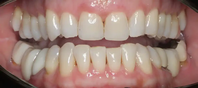 Before full-mouth reconstruction in Southlake, TX at Huckabee Dental