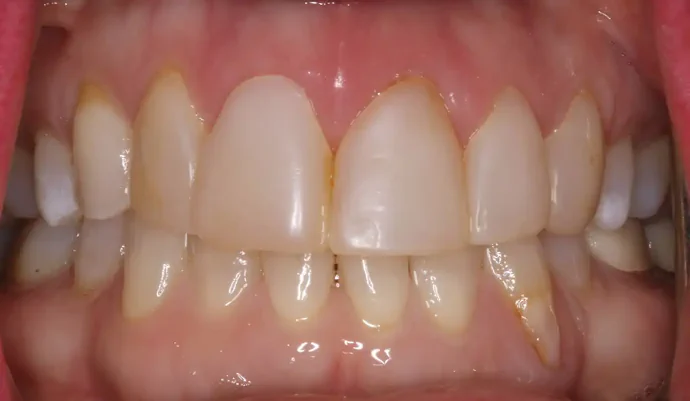 Before old crown replacement in Southlake, TX at Huckabee Dental