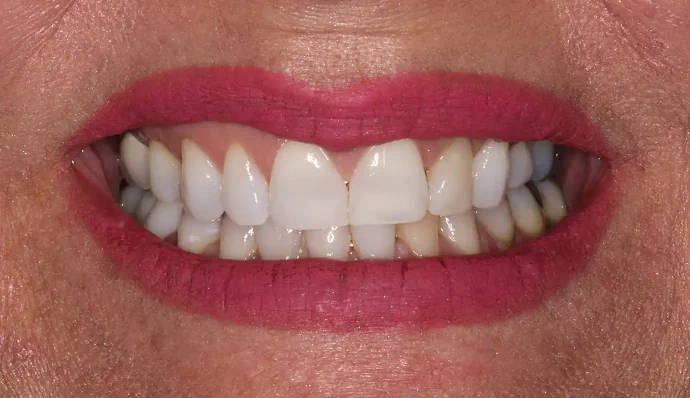 Before a Smile Makeover at Huckabee Dental