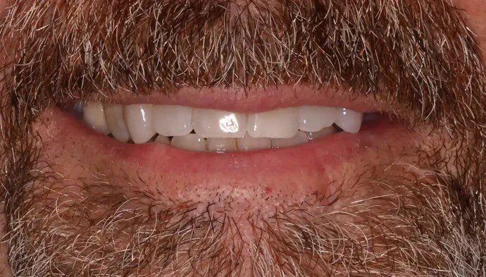 Before Smile Makeover in Southlake, TX at Huckabee Dental