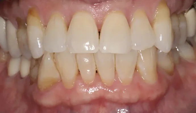 After Smile Makeover in Southlake, TX at Huckabee Dental