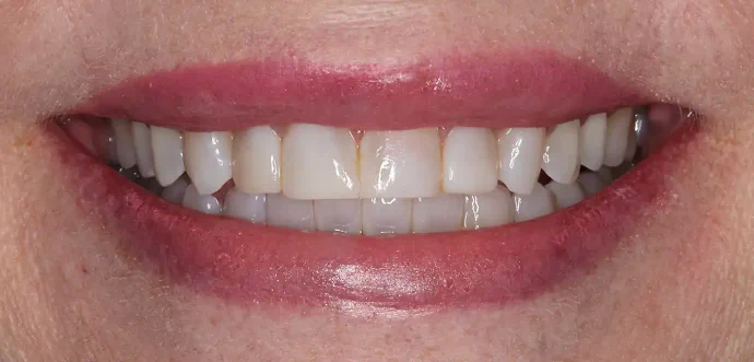 Before teeth whitening and veneers in Southlake, TX at Huckabee Dental