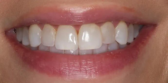 Before Upper Veneers in Southlake, TX at Huckabee Dental
