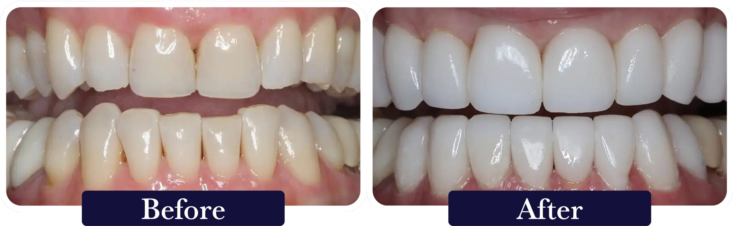 huckabee-smile-gallery-before-after-full-mouth1 A close up of a patient's smile before and after dental veneers at Huckabee Dental in Southlake, TX.