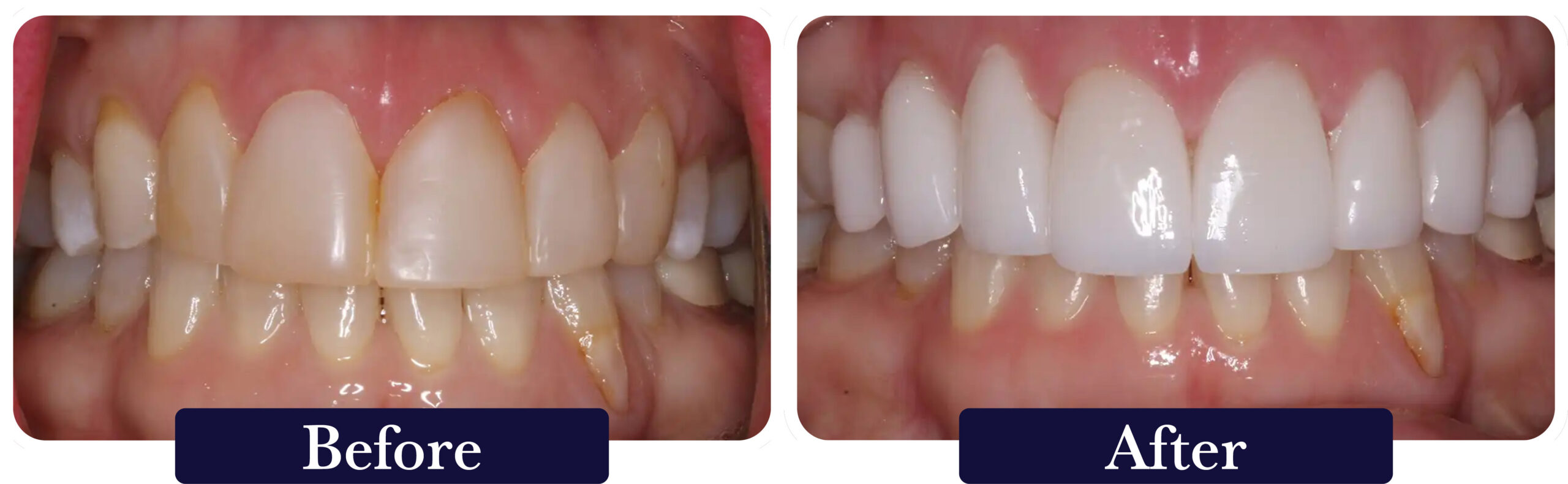 huckabee-smile-gallery-before-after-full-mouth2 A close up of a patient's smile before and after a smile makeover at Huckabee Dental in Southlake, TX.