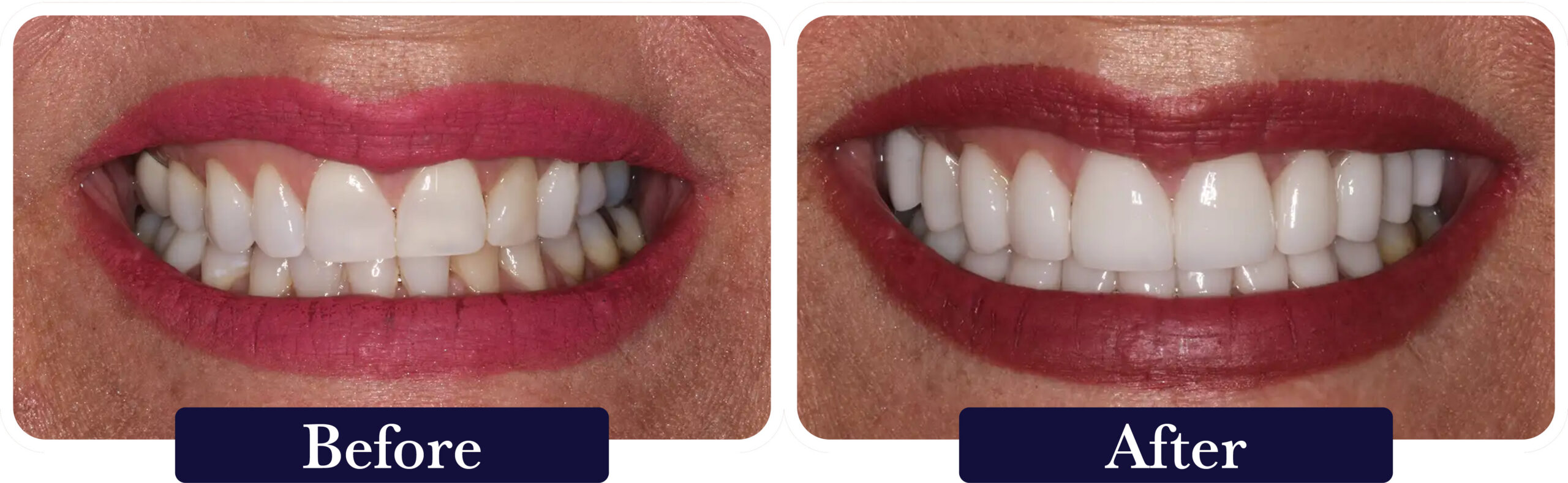 huckabee-smile-gallery-before-after-smile-makeover1 A close up of a patient's smile before and after a smile makeover at Huckabee Dental in Southlake, TX.