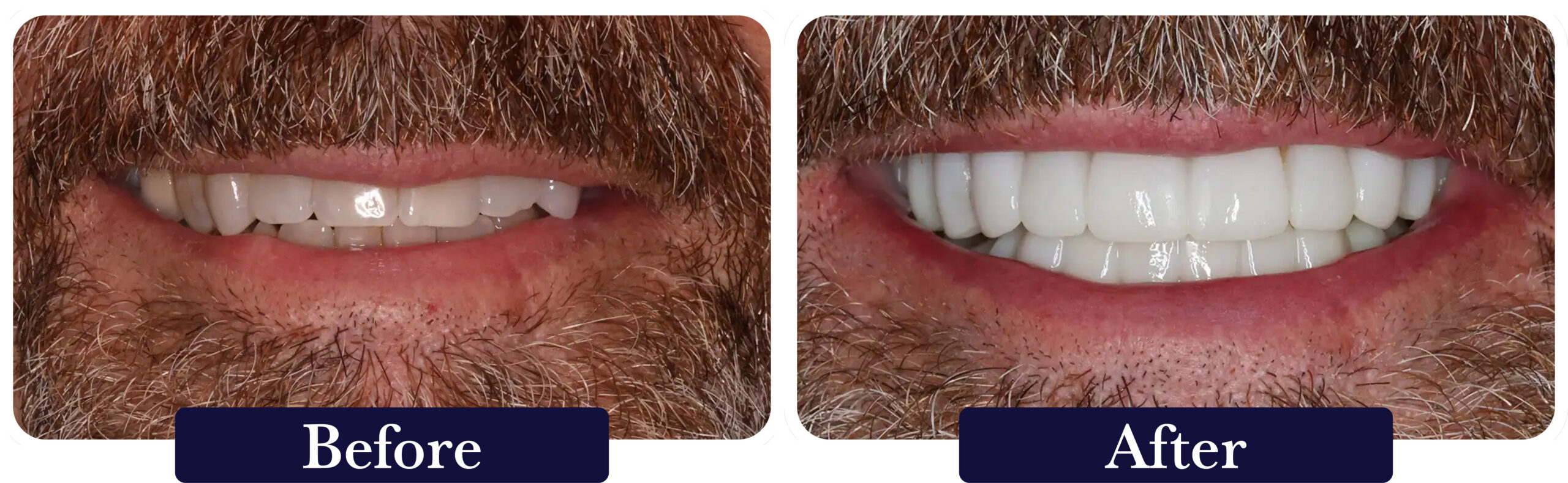 huckabee-smile-gallery-before-after-smile-makeover2 A close up of a patient's smile before and after a smile makeover at Huckabee Dental in Southlake, TX.