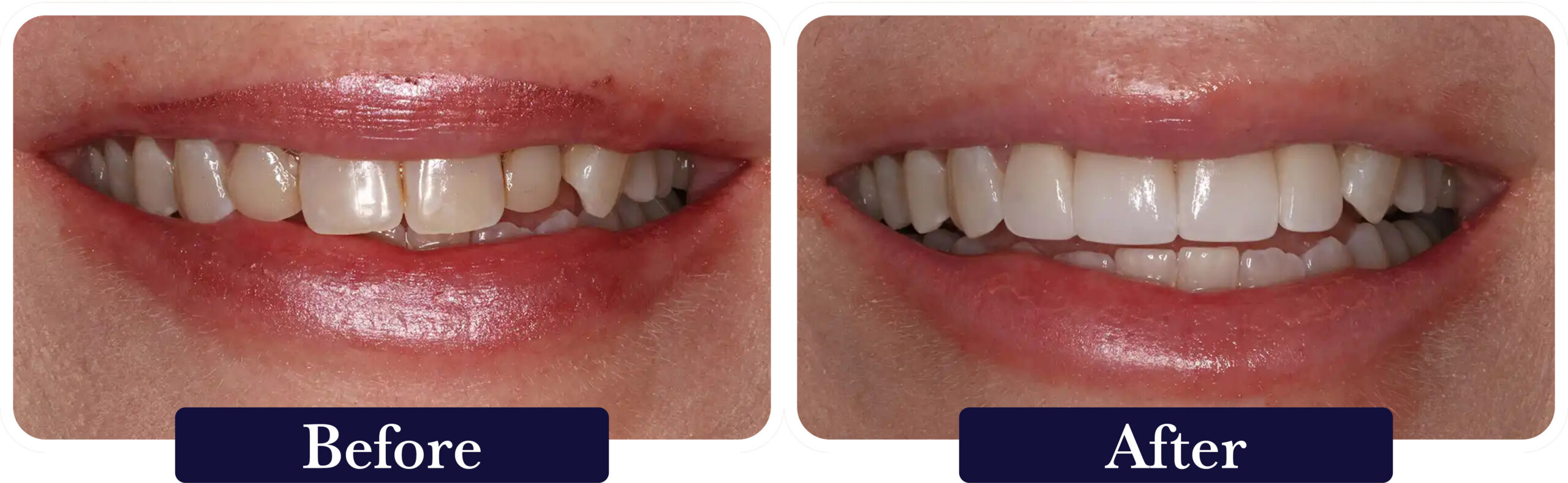 huckabee-smile-gallery-before-after-veneers1 A close up of a patient's smile before and after dental veneers at Huckabee Dental in Southlake, TX.