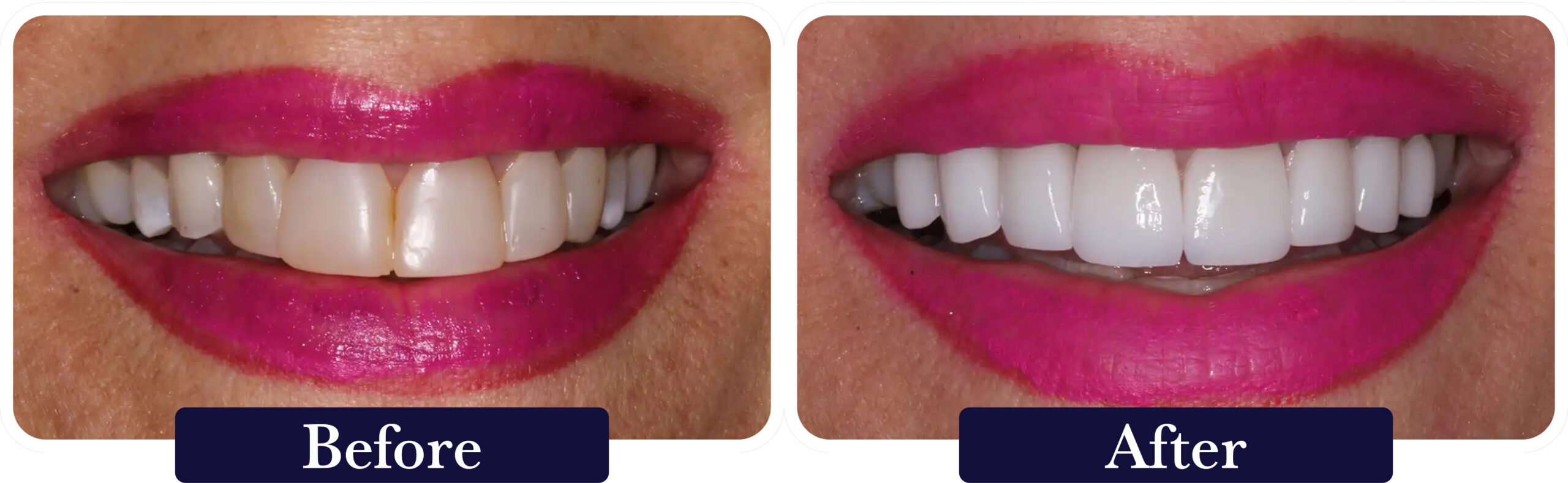 huckabee-smile-gallery-before-after-veneers2 A close up of a patient's smile before and after dental veneers at Huckabee Dental in Southlake, TX.